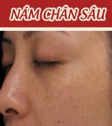 Bạn biết gì về nám da?