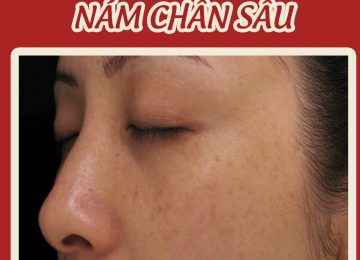 Bạn biết gì về nám da?